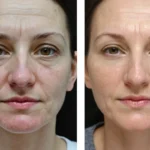 Tretinoin Before and After Effective Skin Treatment